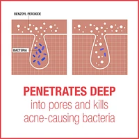Stubborn Acne AM Facial Treatment