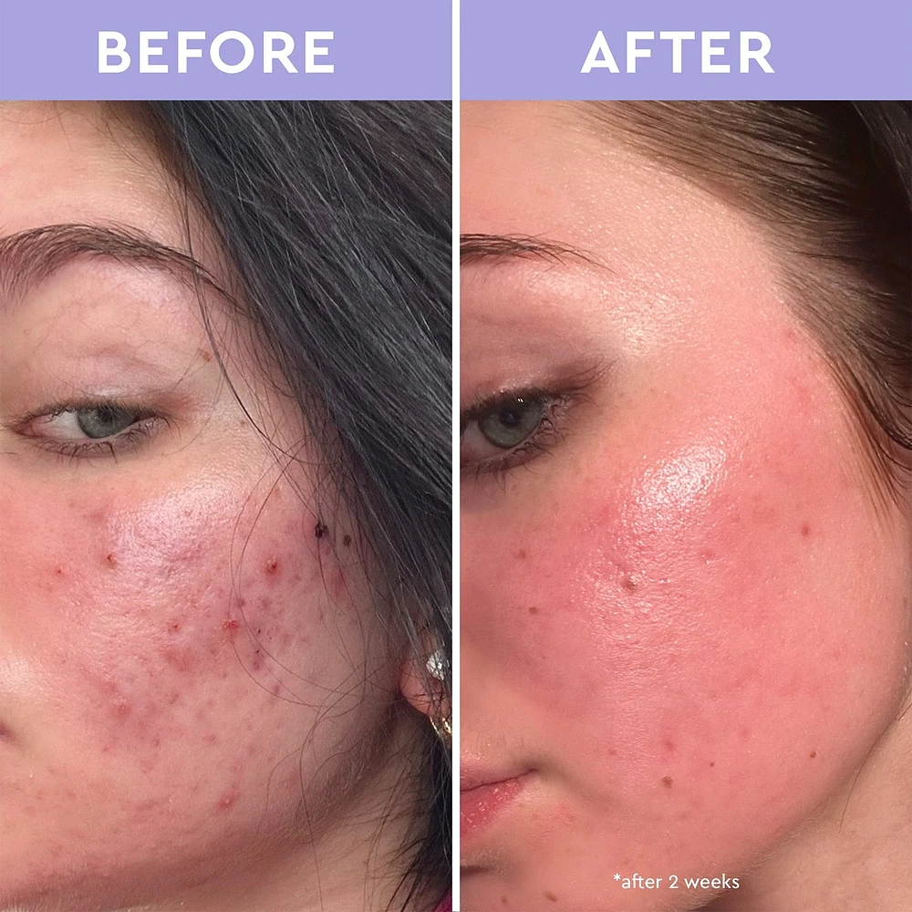 Sérum de traitement purifiant anti-imperfections Spot A Spot
