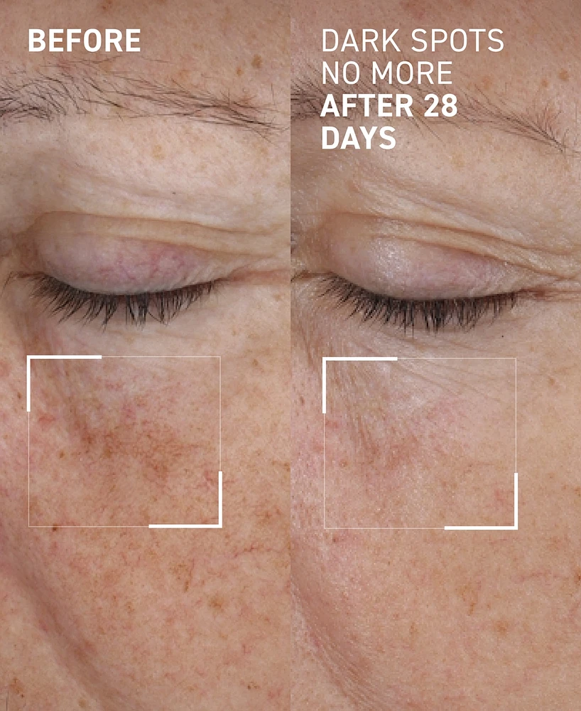 Dr. Brandt Dark Spots No More Triple Acid Spot Minimizing Concentrate, 0.5 oz.