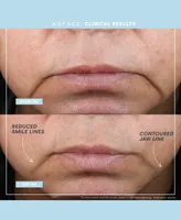 NuFACE 5-Pc. Trinity+ Targeted Facial Toning Set