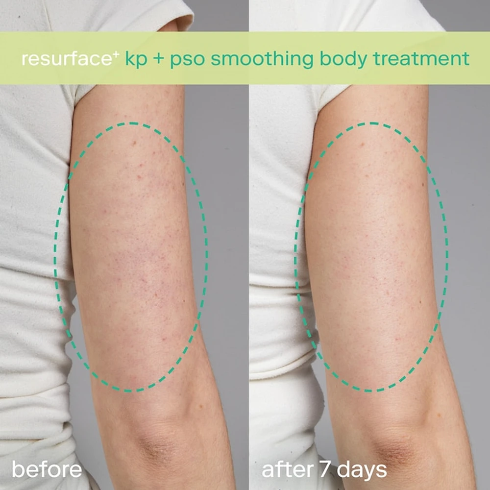 KP+ Psoriasis Smoothing Treatment Body Lotion