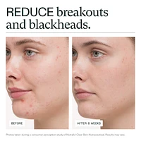 Clear Skin Physician-formulated Supplement for Acne and Breakouts