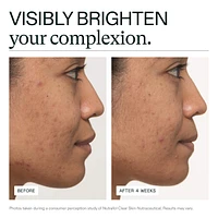 Clear Skin Physician-formulated Supplement for Acne and Breakouts