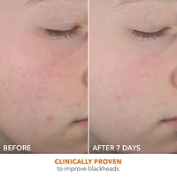 Alpha Beta® On The Spot Eliminator 2% Salicylic Acid Acne Treatment Gel