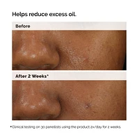 Balancing & Clarifying Serum for Oily Skin and Pore Refinement