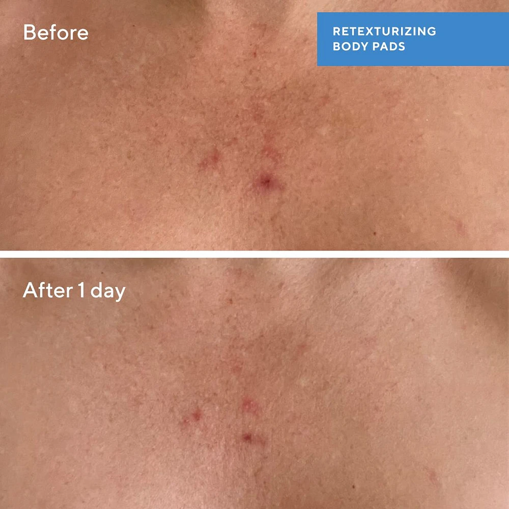 Retexturizing Body Pads with Salicylic Acid