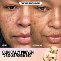 2% Salicylic Acid Acne Gel Moisturizer