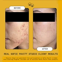 5% Benzoyl Peroxide Acne Treatment Mask with Glycolic Acid