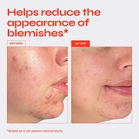 Clear Exfoliating Serum for Blemishes with 10% AHA + BHA Blend